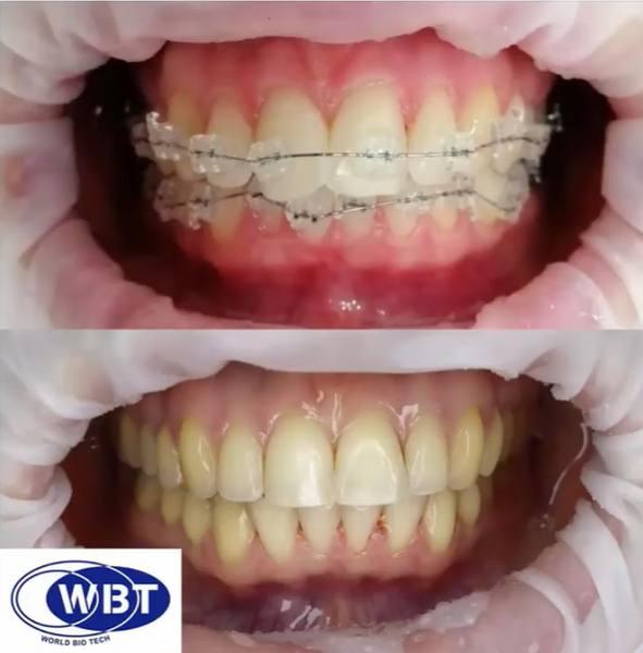 Брекеты эстетические WBT Lucid Roth 022 Lucid фото